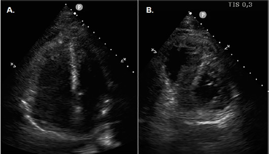 Ecocardiograma transtor&aacute;cico al ingreso. A. Vista apical de 4 c&aacute;maras, fin de s&iacute;stole. Se observa marcada dilataci&oacute;n de cavidades derechas. B. Eje corto paraesternal. Se observa la dilataci&oacute;n del ventr&iacute;culo derecho, con aplanamiento del septum interventricular.