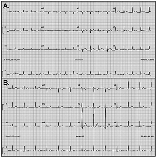 A. Electrocardiograma al ingreso, taquicardia sinusal. B. Electrocardiograma al egreso, ritmo sinusal, frecuencia card&iacute;aca normal con aumento de voltajes a nivel generalizado, diferencia m&aacute;s marcada en precordiales derechas.
