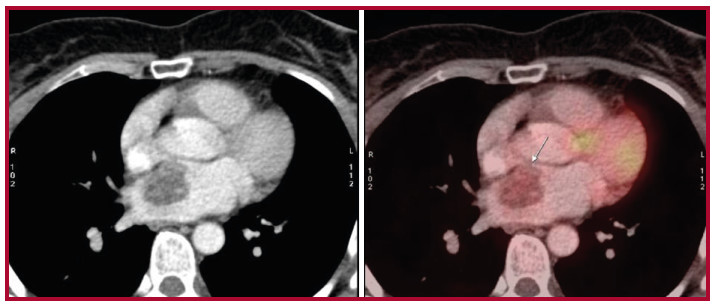 PET que evidencia imagen hipodensa en aur&iacute;cula izquierda con moderada actividad metab&oacute;lica.