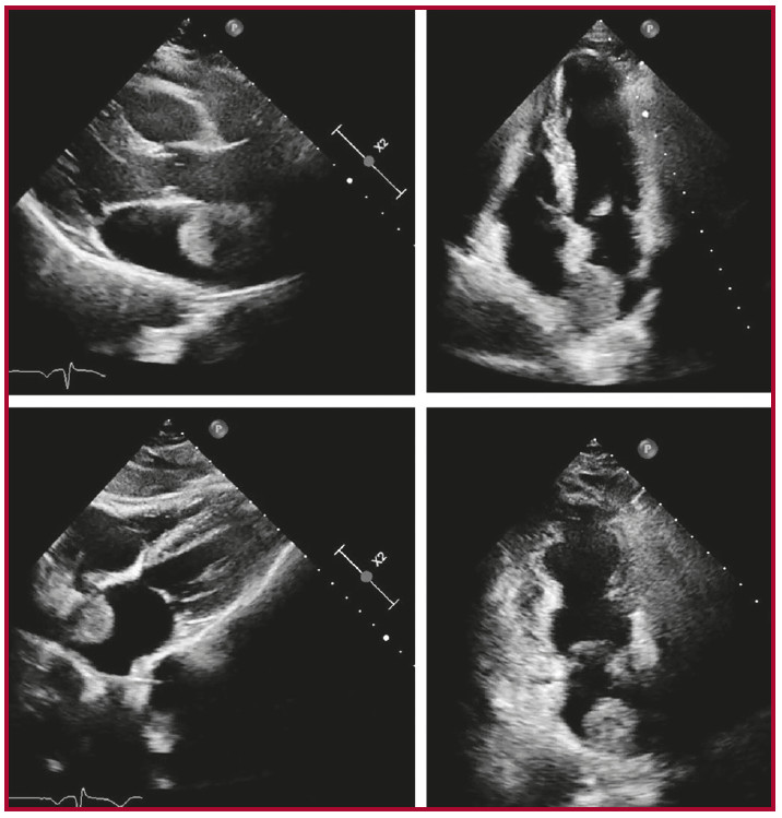 M&uacute;ltiples vistas de ecocardiograma Doppler en las que se evidencia en aur&iacute;cula izquierda imagen heterog&eacute;nea redondeada adherida al septum interauricular.
