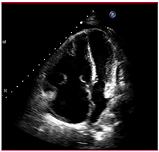 Ecocardiograma Doppler, ventana de 4 cámaras apical: se observa gran dilatación de cavidades derechas, con marcado desplazamiento del septum interventricular, disminución del diámetro del ventrículo izquierdo e insuficiencia tricuspídea grave.