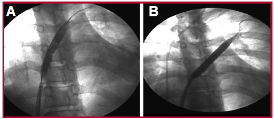 Septostomía atrial con balón. Se realiza dilatación con balón alcanzando diámetro máximo de 5 mm guiado bajo fluoroscopía. A: Inflado de balón sobre guía centrado en el septum interauricular. B: Inflado total del balón.