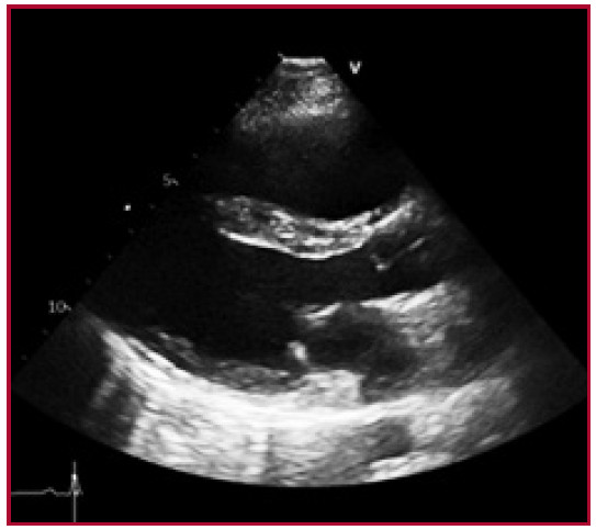 Ventana eje paraesternal largo: se observa mejoría evolutiva del diámetro del ventrículo derecho, con menor compresión hacia ventrículo izquierdo e hipertrofia del septum interventricular.