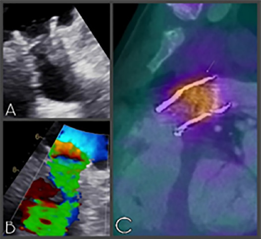 estudios preoperatorios. A, B: Ecocardiograma de v&aacute;lvula pulmonar. C: PET/TC con captaci&oacute;n prot&eacute;sica.