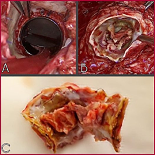 im&aacute;genes intraoperatorias A: v&aacute;lvula a&oacute;rtica indemne. B/C: pr&oacute;tesis en posici&oacute;n pulmonar con claros signos de endocarditis.