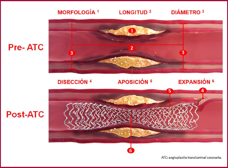 Par&aacute;metros de optimizaci&oacute;n de la inteligencia artificial durante la angioplastia coronaria