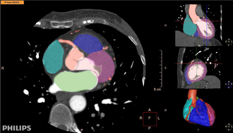 Segmentaci&oacute;n autom&aacute;tica de una tomograf&iacute;a cardiovascular con contraste. El software reconoce las cavidades card&iacute;acas, el miocardio, las coronarias y la aorta ascendente, segmenta con diferentes colores cada una de ellas y la imagen puede ser editada y corregida por el profesional. Software: IntelliSpace Portal. Image and Information Management Software. Version 12.1. Philips Medical Systems Nederland B.V. Veenpluis 6, 5684 PC Best, The Netherlands