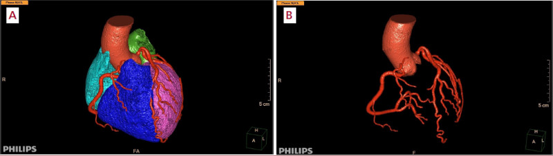 A y B. Reconstrucci&oacute;n cardiovascular autom&aacute;tica derivada de la figura 1 (A) y con &ldquo;eliminaci&oacute;n&rdquo; de todas las estructuras para visualizar exclusivamente la aorta y el &aacute;rbol coronario (B). Software: IntelliSpace Portal. Image and Information Management Software. Version 12.1. Philips Medical Systems Nederland B.V. Veenpluis 6, 5684 PC Best, The Netherlands