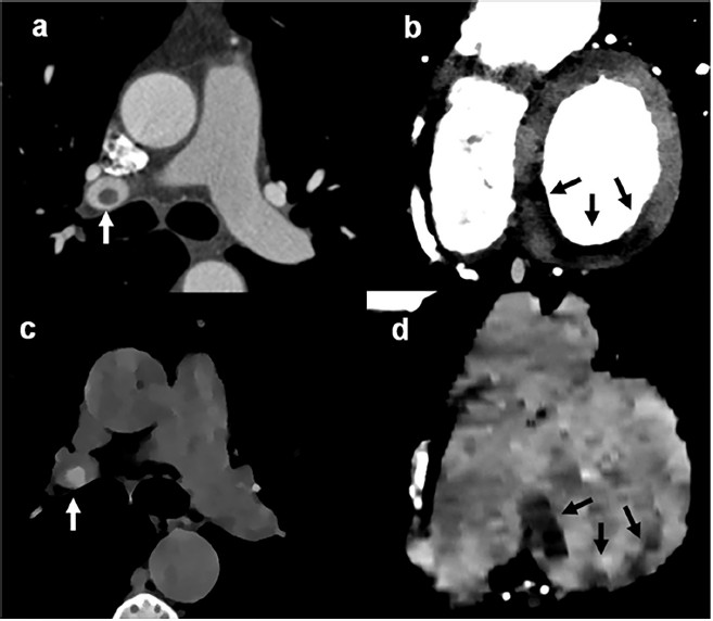 Tomograf&iacute;a computarizada card&iacute;aca realzada con contraste (paneles a y b) que muestra tromboembolismo pulmonar (panel a, flecha) y defecto de perfusi&oacute;n mioc&aacute;rdico de la pared inferior (panel b, flechas). Im&aacute;genes de densidad de electrones sin contraste obtenidas a partir del estudio para score de calcio (paneles c y d) que muestran los mismos hallazgos sin administraci&oacute;n de contraste. El trombo se ve de color blanco, relacionado con valores altos de densidad de electrones (panel c), mientras que el defecto de perfusi&oacute;n se identifica como un &aacute;rea con baja densidad de electrones (panel d).