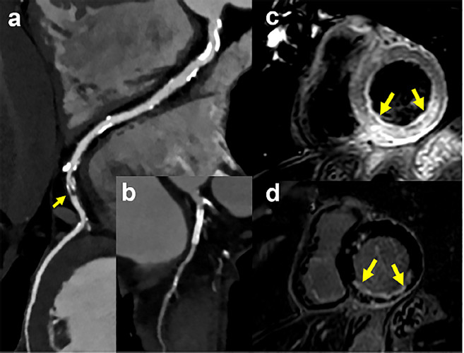 Angiotomograf&iacute;a coronaria, que muestra una arteria coronaria derecha grande y dominante con una lesi&oacute;n distal severa (panel a, flecha), y un stent permeable en una arteria circunfleja peque&ntilde;a (panel b). Las im&aacute;genes de resonancia magn&eacute;tica card&iacute;aca (paneles c y d) en vistas de eje corto basal, muestran un infarto de miocardio de la pared inferior (panel c: imagen ponderada en T2, panel d: realce tard&iacute;o)