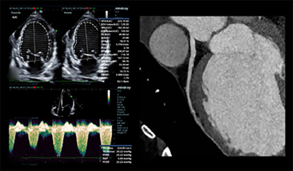 Ecocardiograma Doppler color realizado durante la internaci&oacute;n donde se evidencia FEVI 29% (A) y jet de insuficiencia tricusp&iacute;dea leve (B); angiotomograf&iacute;a coronaria, con arteria descendente anterior sin lesiones (C).