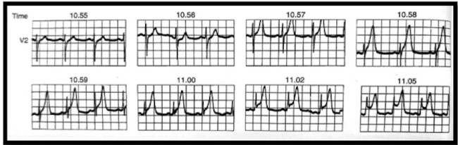 Se observa la evoluci&oacute;n electrocardiogr&aacute;fica de una obstrucci&oacute;n s&uacute;bita total de la arteria descendente anterior. N&oacute;tese la evoluci&oacute;n de onda T alta y acuminada desde 10:55 hasta 10:58 (onda de 13 mm) como primera manifestaci&oacute;n protectora del epicardio (adenosina- K+ ATP dependiente) con elevaci&oacute;n del segmento ST. La onda T alta y acuminada se debe a la entrada brusca de K+ al epicardio. El segmento ST est&aacute; relacionado con el calcio, que act&uacute;a como buffer, a un pH muy disminuido, en el centro de la isquemia.