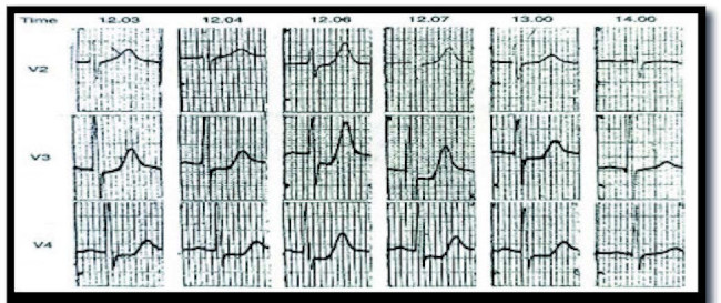 La evoluci&oacute;n electrocardiogr&aacute;fica de una obstrucci&oacute;n s&uacute;bita subtotal de la arteria descendente anterior, expresado con ondas T altas y acuminadas, y segmento ST deprimido, que sugiere una isquemia subendoc&aacute;rdica aguda. N&oacute;tese la evoluci&oacute;n de las ondas T altas y acuminadas de 15mm. A pesar de que la isquemia es subendoc&aacute;rdica, la adenosina - K+ ATP dependiente protegen el epicardio. (5) N&oacute;tese que a las 2 horas de comenzado la isquemia, aparece una onda Q m&iacute;nima subendoc&aacute;rdica. 