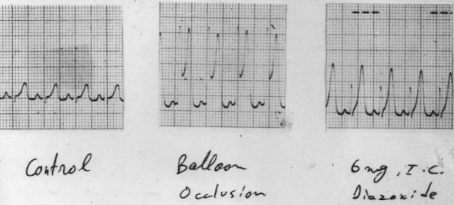 Experimento en perro. A la izquierda registro en reposo. En el centro introducci&oacute;n de cat&eacute;ter bal&oacute;n y obstrucci&oacute;n s&uacute;bita de la arteria coronaria descendente anterior durante 2 minutos. Se observa la t&iacute;pica onda T alta y acuminada de 15 mm de voltaje. A la derecha inyecci&oacute;n intracoronaria de 5mg de diaz&oacute;xido. Se registra una onda T similar a la onda T isqu&eacute;mica. El diaz&oacute;xido estimula la secreci&oacute;n de adenosina, y esta aumenta la concentraci&oacute;n de K+ en el epicardio.