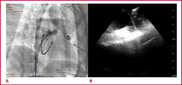 A. Radioscopía que evidencia orejuela derecha y aneurisma, con catéter de ablación en su interior. B. Eco-cardiografía intracardíaca con vista desde aurícula derecha donde se observa orejuela derecha y aneurisma