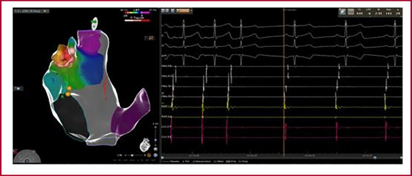 Mapa de activación con aislamiento de orejuela derecha y corte de la taquicardia durante las aplicaciones.
