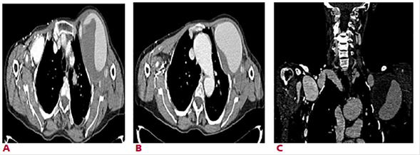 Tomograf�a computarizada A. Corte axial que muestra ambas dilataciones vasculares a nivel de las arterias subclavias. B. Corte axial que muestra la dilataci�n aneurism�tica de la arteria subclavia izquierda, dilataci�n de la aorta con coartaci�n de la misma. C. Corte coronal que muestra dilataci�n aneurism�tica de ambas arterias subclavias, la izquierda con trombo en su pared.
