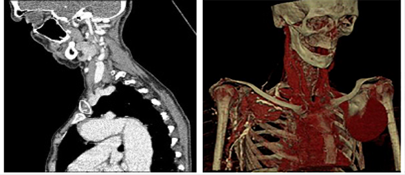 Tomograf�a computarizada. A. Corte sagital que muestra la dilataci�n de la aorta con la coartaci�n a�rtica. B. Reconstrucci�n volum�trica que muestra ambas dilataciones aneurism�ticas de las arterias subclavias.