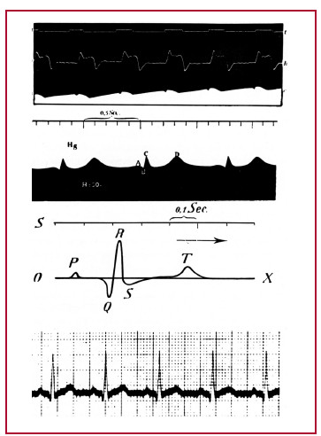 Ondas obtenidas por A.D. Waller (arriba); ondas obtenidas por Einthoven con su electrómetro capilar mejorado (centro); trazado electrocardiográfico mediante el galvanómetro de cuerda (abajo).