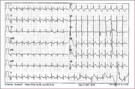 Beb� de 3 meses, todav�a con predominancia del ventr�culo derecho. Ver onda R en V1