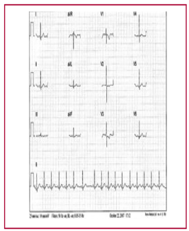 Ni�o de 6 a�os sin hipertrofia fisiol�gica exc�ntrica, proba blemente hipertrofia fisiol�gica conc�ntrica.
