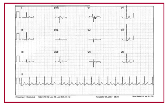 Ni�o de 9 a�os con hipertrofia exc�ntrica apical con ondas R altas en V4 y V5