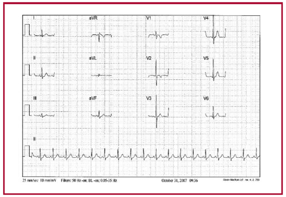 Ni�o de 9 a�os con hipertrofia fisiol�gica exc�ntrica ante roseptal, con ondas R altas en V2, V3 y V4