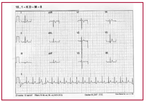 Ni�o de 5 a�os con hipertrofia exc�ntrica posteroseptal, con onda S en V2 de 40 mm.