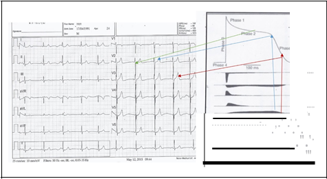 ECG de var�n de 22 a�os. 