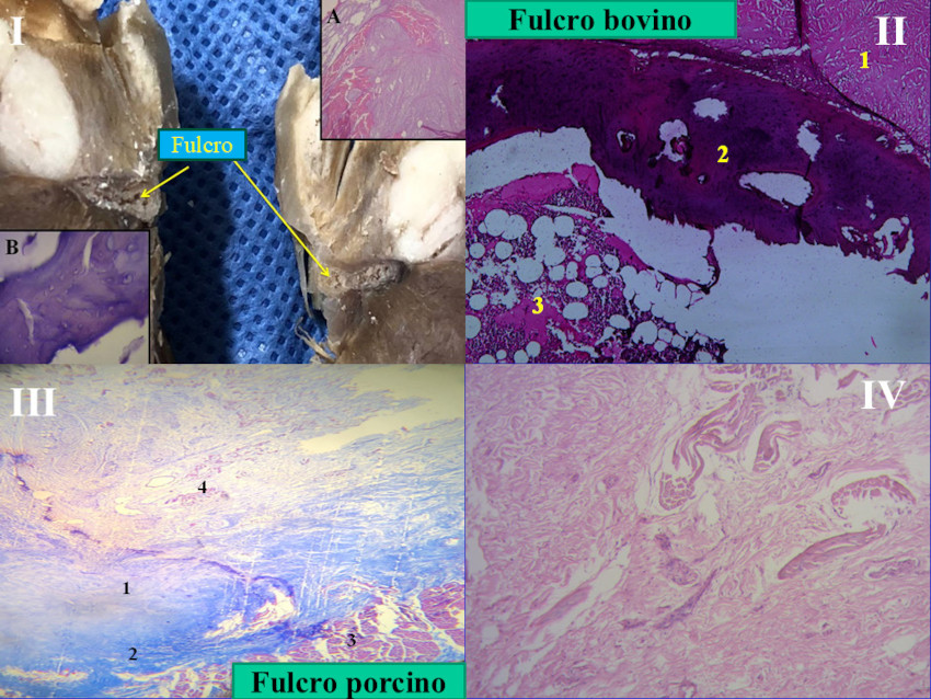 I. Fulcro card�aco en el coraz�n bovino. Se observa bien la cortical y la m�dula del fulcro. A: Se observa la inserci�n de las fibras mioc�rdicas en el tejido condroide. B: Tinci�n con H&E a gran aumento (40x) que muestra una trab�cula �sea con osteoblastos y l�neas segmentarias. La estructura forma el andamiaje del tejido �seo trabecular similar a las zonas metafisiarias de crecimiento de los huesos largos, Se visualizan trab�culas �seas con osteoblastos y l�neas segmentarias secundarias a aposici�n �sea. II. Fulcro bovino, cortical y m�dula. En la cortical se observa tejido osteocondroide parcialmente calcificado y en m�dula trab�culas osteocondroides que dan una estructura esponjosa con elementos de medula �sea en el espacio. 1: miocardio. 2: cortical del fulcro. 3: m�dula del fulcro. III. Fulcro de porcino: 25x, coloraci�n de Masson. 1: fulcro cartilaginoso de porcino. 2: tejido fibroso peri-fulcro. 3: septum. 4: se observan entremezclados miocardiocitos de conducci�n, nervios, y ganglios llegando al fulcro. IV. Area central de un fulcro de coraz�n humano. Tend�n fibroso y miocardiocitos, H&E (25x). H&E: hematoxilina-eosina.