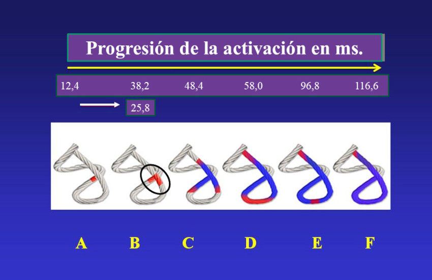 Modelo de la cuerda. Secuencia de activaci�n (A-F) en el miocardio continuo seg�n nuestra investigaci�n. Se observan los tiempos de propagaci�n. Los 25,8 milisegundos en B representan el retardo de la estimulaci�n para pasar de la bandeleta descendente en A a la ascendente en B (detallado en el c�rculo negro). 