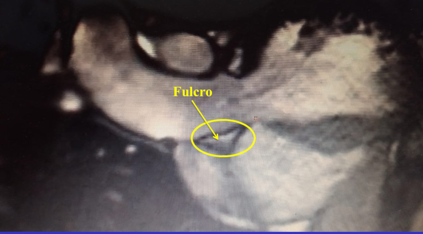 El fulcro card�aco en di�stole. Resonancia en humano adulto.
