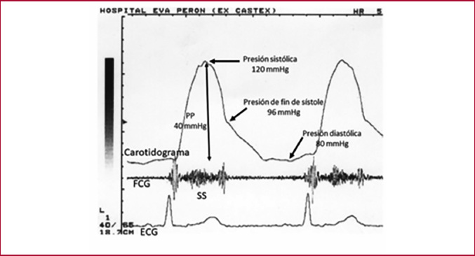 C�lculo de la presi�n de fin de s�stole mediante el carotidograma calibrado con la presi�n arterial medid con esfigmoman�metro. PP: presi�n del pulso, FCG: fonocardiograma, ECG: electrocardiograma, SS: soplo sist�lico registrado en mesocardio