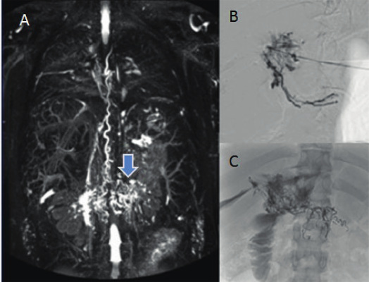 A. Linfograf�a por resonancia magn�tica, la flecha se�ala la red linf�tica hepatoduodenal tortuosa y dilatada. B. Linfograf�a por cateterismo. C. Linf�ticos hepatoduodenales embolizados.