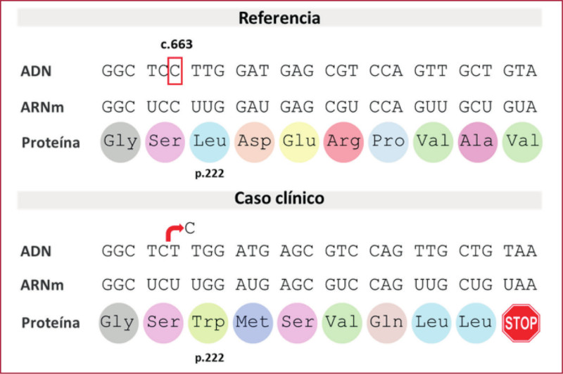 An�lisis de la variante c.663del en el gen BMPR2. Se comparan las secuencias de ADN, ARNm y prote�na entre el caso y la secuencia referencia. En el caso se ilustra la deleci�n de una citosina (C) en el nucle�tido 663 (flecha roja) que genera un corrimiento del marco de lectura y forma un cod�n de terminaci�n prematuro (STOP). Secuencias de referencia BMPR2: NG_009363.1 (gen), NM_001204.7 (transcripto) y NP_001195.2 (prote�na).