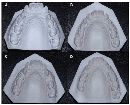 (A)
Plaster model prior to RME (T0) (B) as well as three months (T1), (C) one year
(T2) and (D) three years (T3) after expansion.