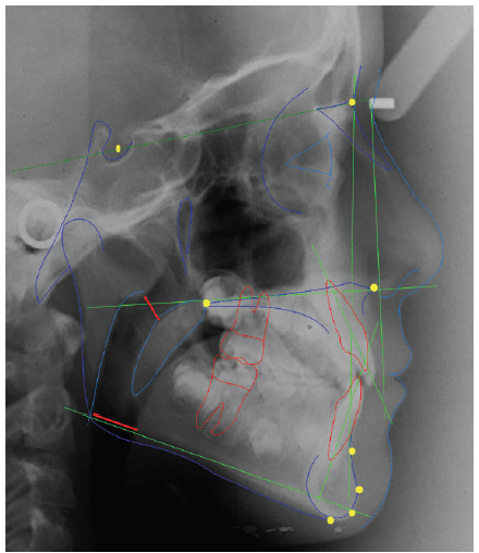 Lateral
cephalogram: Cephalometric analysis of hard and soft tissues; demarcation of
points, lines and planes.