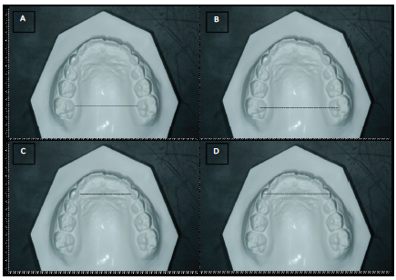 Plaster
model measures: (A) gingival intermolar distance; (B) cusp intermolar distance;
(C) gingival intercanine distance; and (D) cusp intercanine distance. 
