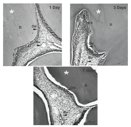 Representative
photomicrographs of the rat first molar dental pulp 1 day, 3 days, and 7 days
after the cavity preparation and immediate glass-ionomer
cement restoration. At 3 days, an area of intense inflammatory infiltrate,
concentrated subjacent to the cavity preparation, and disorganization of the odontoblast layer are evident (arrow). At 7 days,
inflammation was mild, and the odontoblast layer was
organized, similar to the first day. (*) Location of the cavity preparation; (Od) odontoblast layer; (D) dentin;
(II) inflammatory infiltrate; (Bv) blood vessel. Hematoxylin-
Eosin stainning.