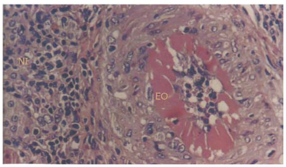 Figure 3. Photomicrography
of the kidney of an animal of group I (sham) in the area not subjected to
ischemia, showing the endarteritis obliterans (EO) associated with interstitial nephritis (IN). The
aspects were similar in all the remaining animals of the three groups (HE – 400
x).