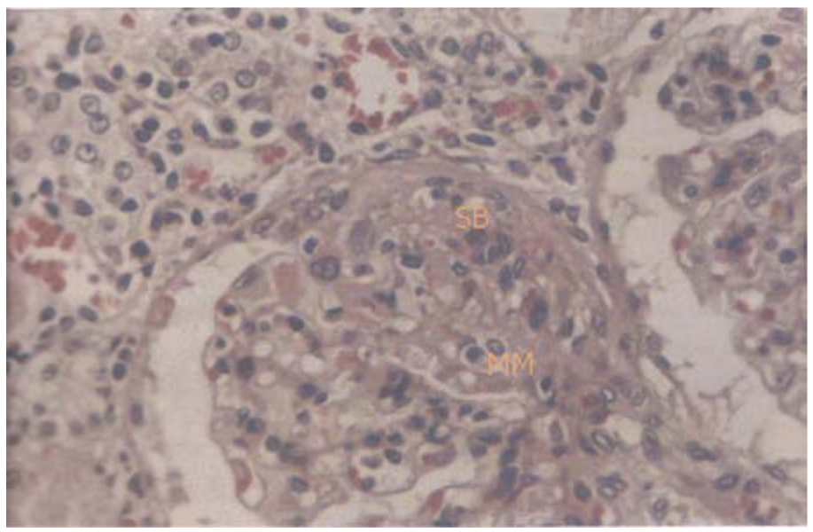 Figure 4. Photomicrography of the kidney of
an animal of group I (sham) in the area not subjected to ischemia, showing
focal glomerular change with a slight increase of the mesangial matrix and cellularity (MM), as
well as synechia of both the parietal and visceral folium and Bowman’s capsule (SB). The aspects were
similar in all the remaining animals of the three groups (HE – 400 x).