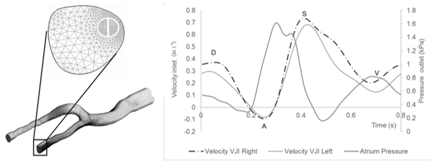 Figure 2. Generated mesh of venous model with the catheter inserted into the right internal jugular vein. Enlarged image of the hexahedral elements near the wall of the vessel and the boundary layer. Waveforms of the blood flow in the internal jugular vein and of the pressure in the atrium.