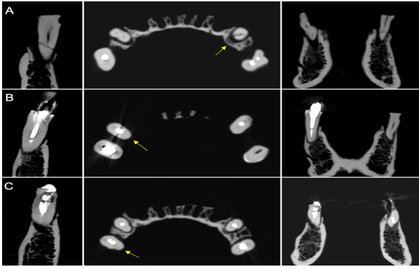 Figure 1. CBCT i-Cat� reconstructions. Parasagittal, axial (arrow) and coronal slices showing the VRF in (A) non-restored teeth, (B) in teeth with MP and (C) with FGP.