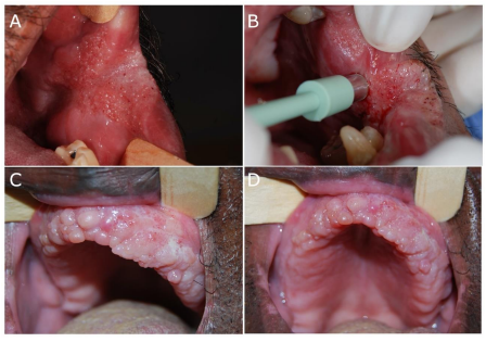Figure 1. 48 years-old man, driver, melanoderma with asymptomatic diffuse mulberry lesions (moriform stomatitis) on the jugal mucosa (A), lips and upper alveolar ridge; incisional biopsy (B) confirmed the diagnosis of PCM. 59 years-old man, rural worker, melanoderma with symptomatic diffuse moriform lesions on the alveolar ridge (C, D)