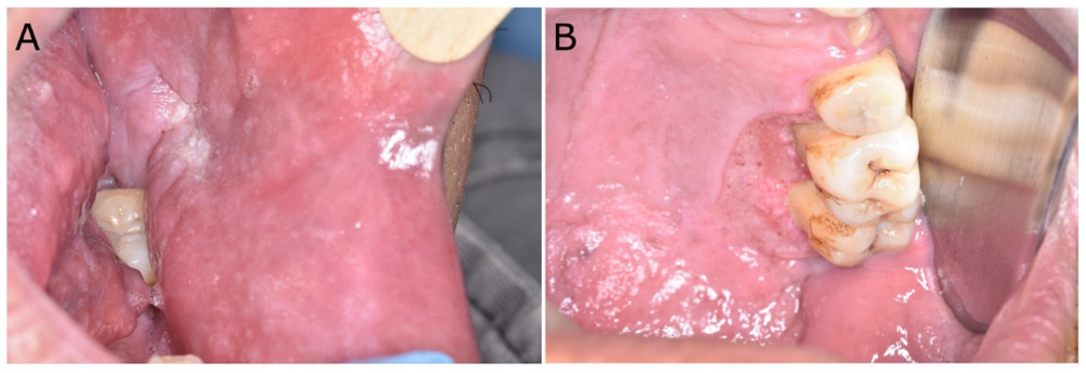 Figure 2. 56 years-old man, bricklayer, melanoderma with swelling and diffuse lesions on the jugal mucosa (A), and palate (B). Incisional biopsy (B) confirmed the diagnosis of histoplasmosis.
