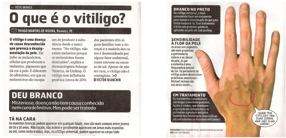 O que &eacute; vitiligo?