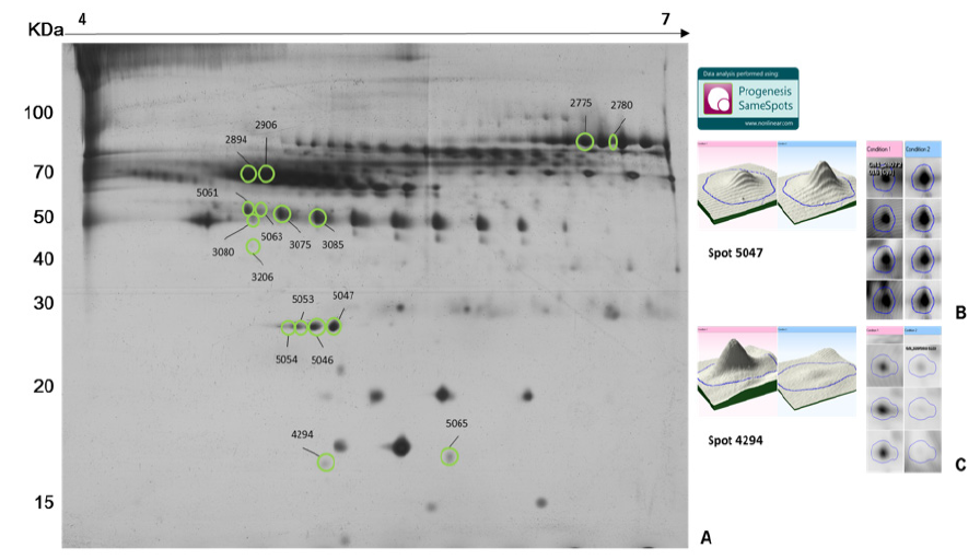 Figura 3. Análisis
de imágenes mediante Progenesis SameSpots v4.5 en plasma inmunodepletado de
pacientes LLA-B y controles. A. Gel
representativo 1 teñido con plata donde se ubican los spots de proteína diferencialmente expresados con un P<0,05 y un
fold change> 2. B. spot 5047: vista 3D en un mismo gel y
vista 2D en varios geles. C. spot 4294: vista 3D en un mismo gel y
vista 2D en varios geles.