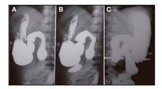 A. Buen vaciamiento g&aacute;strico con relleno del duodeno y dilataci&oacute;n ileal en la que se observa antiperistaltismo previa a la anastomosis del colon. B. El vaciamiento ileal est&aacute; enlentecido, y se realiza a trav&eacute;s de una anastomosis de peque&ntilde;o calibre que permite la repleci&oacute;n total del colon (C).