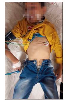 At admission to the Emergency Department, the patient was exhausted, sluggish and cachectic enough not to stand up. He did not communicate verbally, did not answer questions, and avoided eye contact.