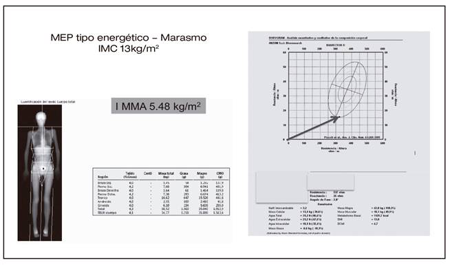 DXA de cuerpo completo y BIA-BIVA, combinados: datos característicos de depleción severa de compartimentos corporales en una desnutrición grave: reducción intensa de la masa grasa e índice de masa muscular apendicular (IMMA) por DXA, junto a bajo ángulo de fase con vector de BIVA situado en cuadrante ínfero-externo sobre elipse de tolerancia del 95% de la población control (datos de BIA-BIVA).